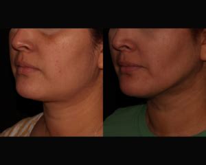 buccal fat reduction scottsdale|Melt Aesthetics and Liposuction Scottsdale.